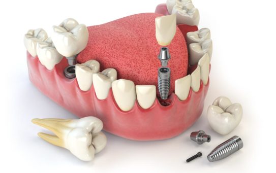 Dentures & Partial Dentures