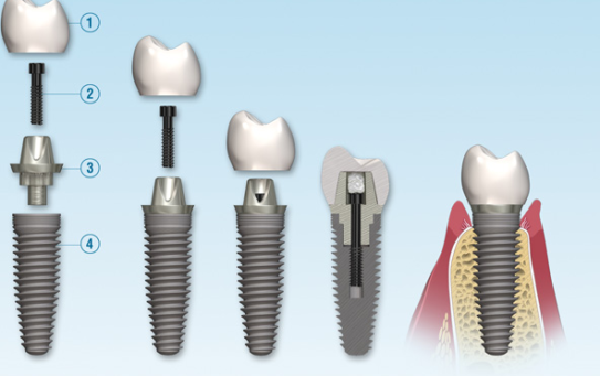 Implants